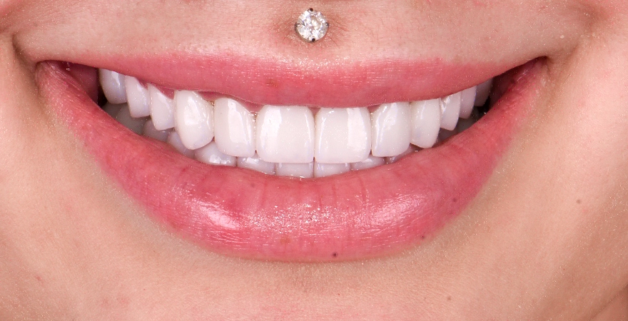 sonrisa-con-carillas-blancas