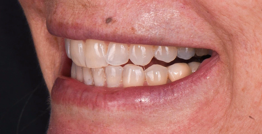 sonrisa-con-dientes-amarillos