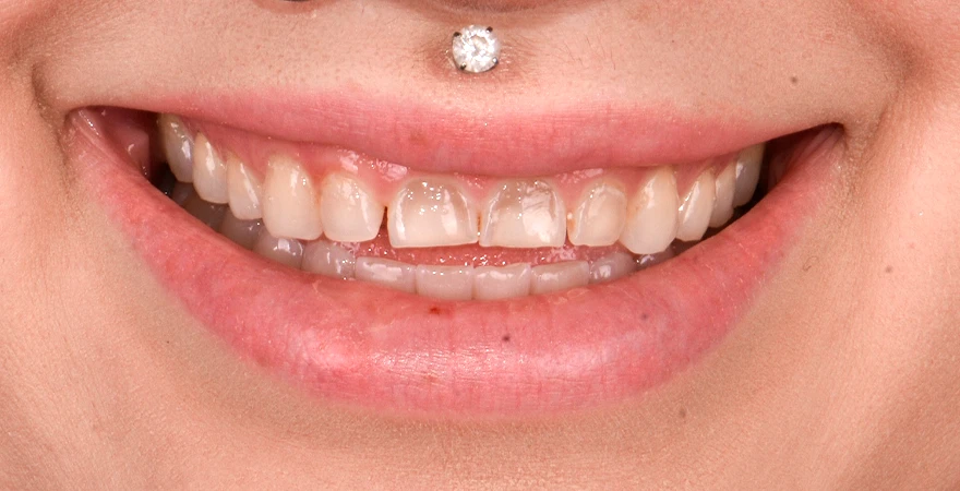 sonrisa-con-dientes-amarillos