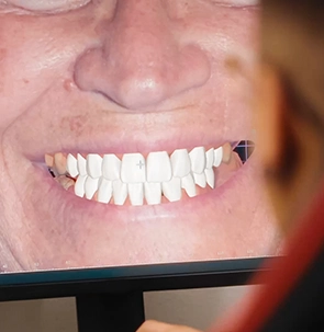 Consigue una sonrisa de aspecto natural en Paradise Dental Los Cabos con carillas y odontología estética.